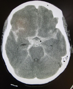 Figura 4. Hemorragia Cerebral Subaracnóide. Seta Preta mostrando o sangue em branco, em toda superfície cerebral. 