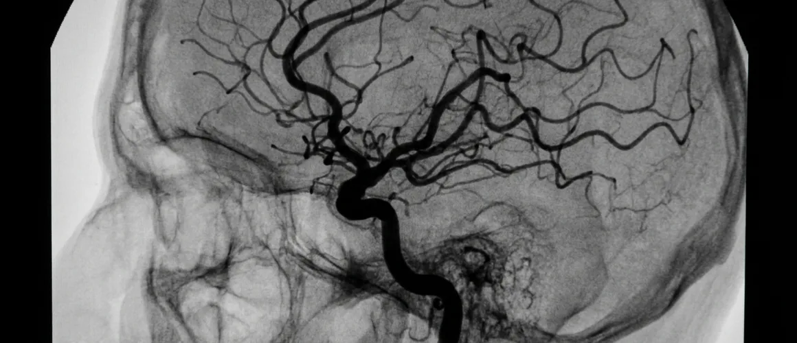 Angiografia cerebral mostrando a árvore arterial do cérebro em projeção lateral