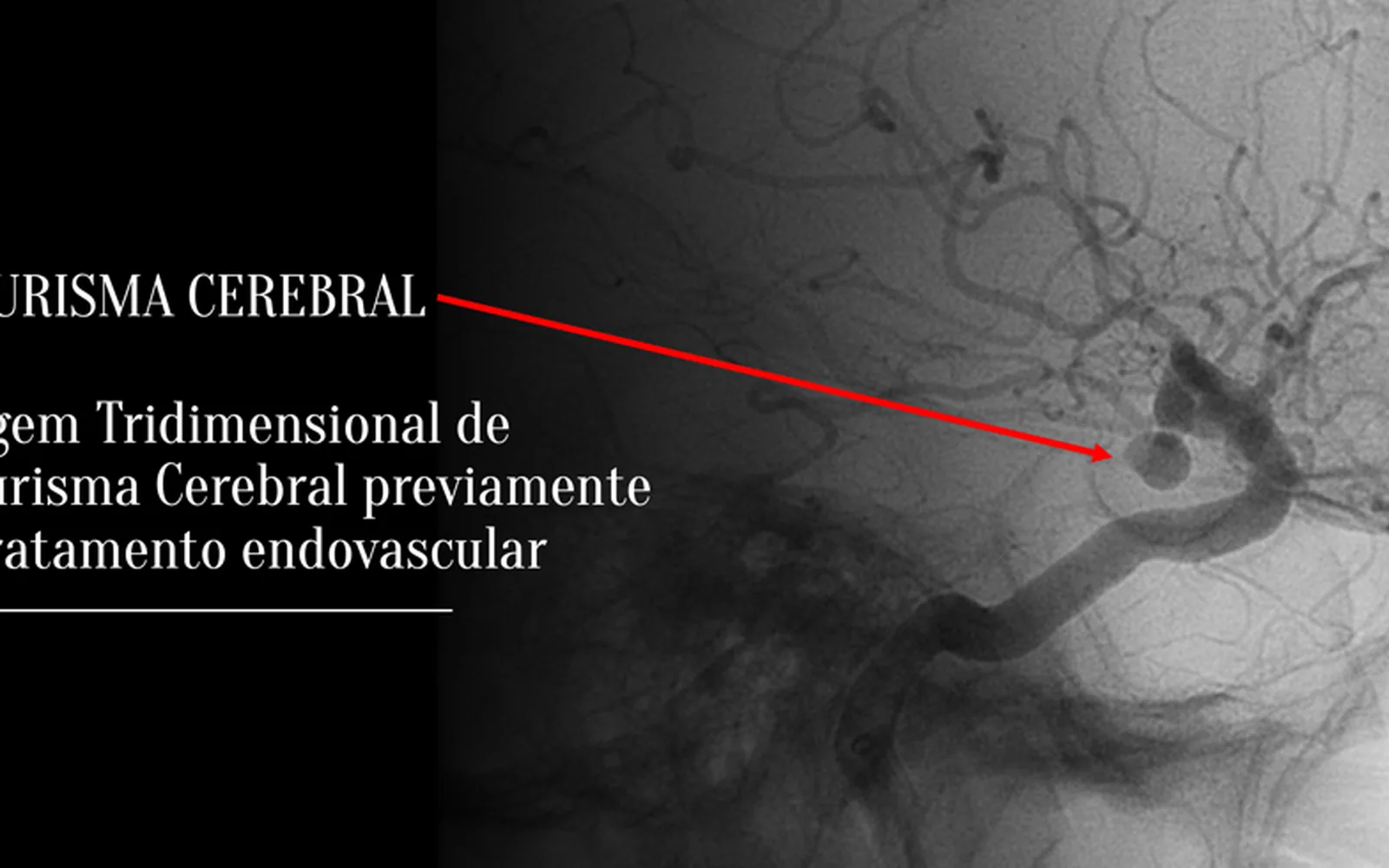 O que é um aneurisma cerebral?