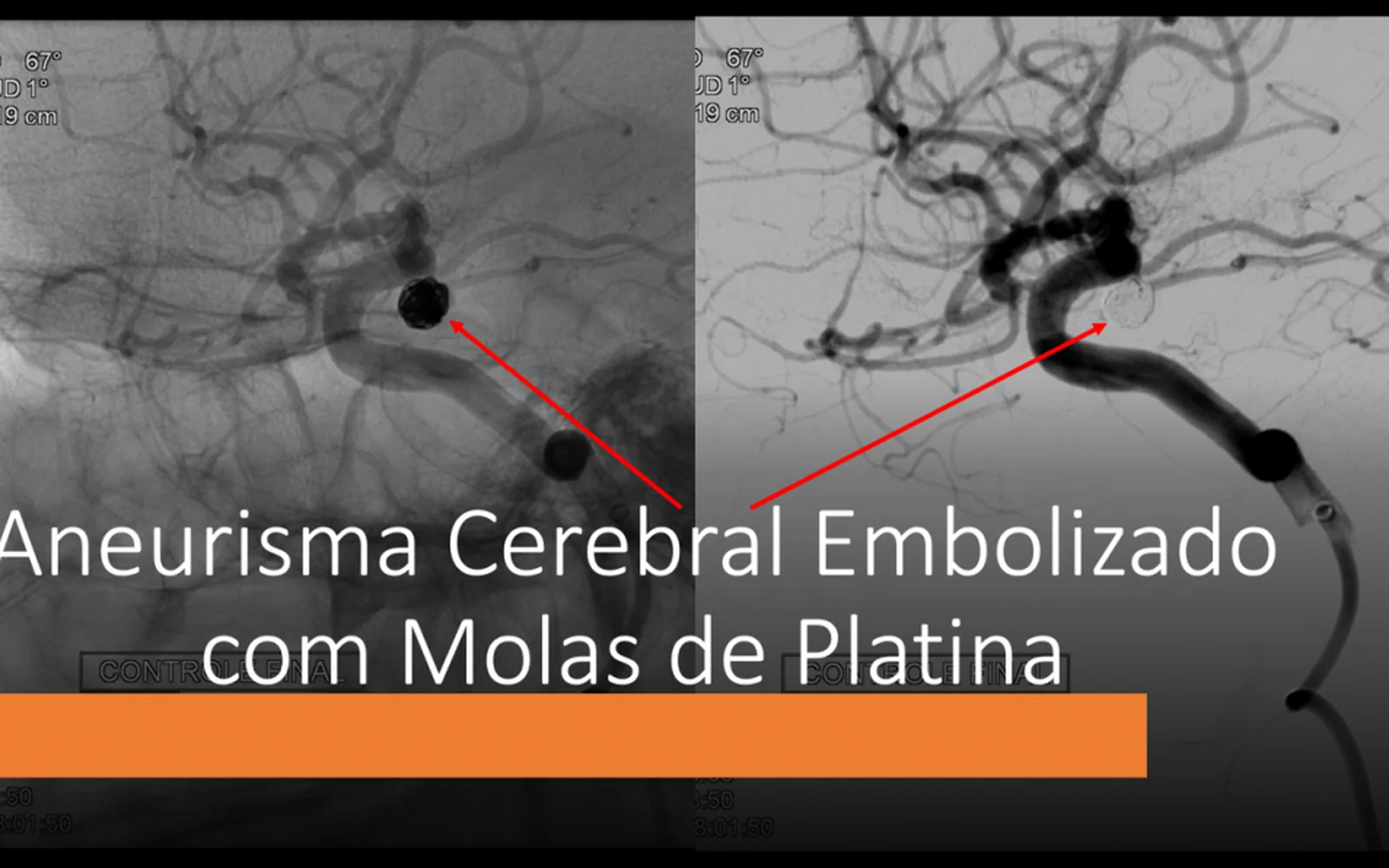 Você sabe quando tratar seu aneurisma cerebral?