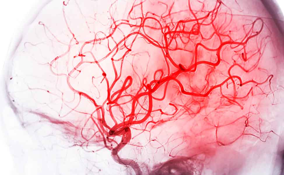 Imagem de angiografia cerebral de fluoroscopia em radiologia de intervenção mostrando artéria cerebral